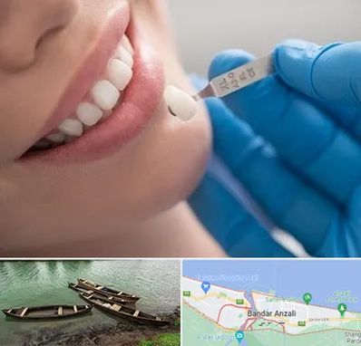 مرکز لمینت دندان در بندر انزلی