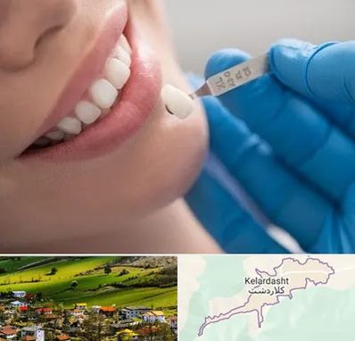 مرکز لمینت دندان در کلاردشت