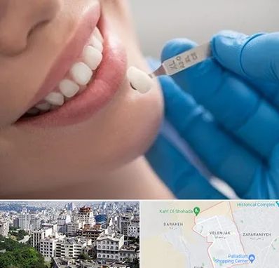 مرکز لمینت دندان در ولنجک