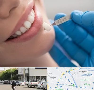 مرکز لمینت دندان در قدوسی شرقی شیراز