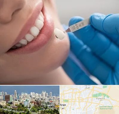 مرکز لمینت دندان در شرق تهران