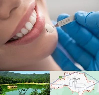 مرکز لمینت دندان در بهشهر