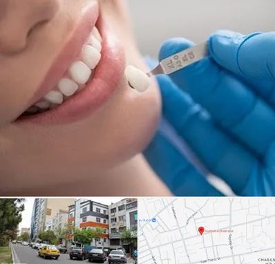 مرکز لمینت دندان در هفده شهریور تبریز