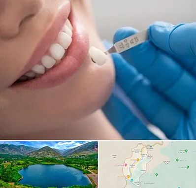 مرکز لمینت دندان در رودبار