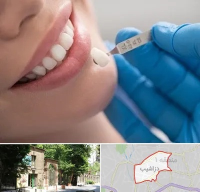 مرکز لمینت دندان در دزاشیب