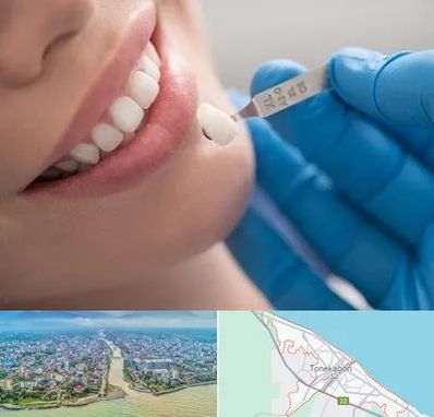 مرکز لمینت دندان در تنکابن