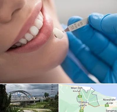 مرکز لمینت دندان در چالوس