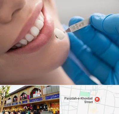 مرکز لمینت دندان در 15 خرداد