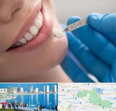 مرکز لمینت دندان در چیتگر