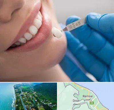 مرکز لمینت دندان در رامسر