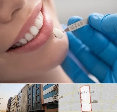 مرکز لمینت دندان در نجات اللهی