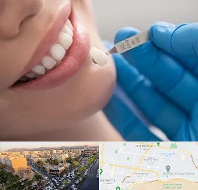 مرکز لمینت دندان در تهرانپارس