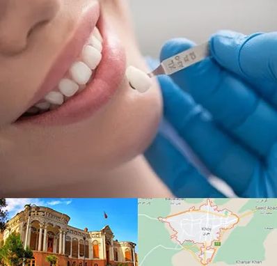 مرکز لمینت دندان در خوی