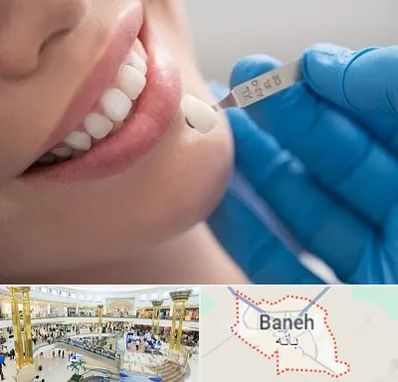 مرکز لمینت دندان در بانه