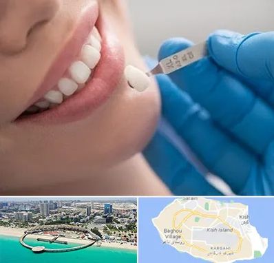 مرکز لمینت دندان در کیش