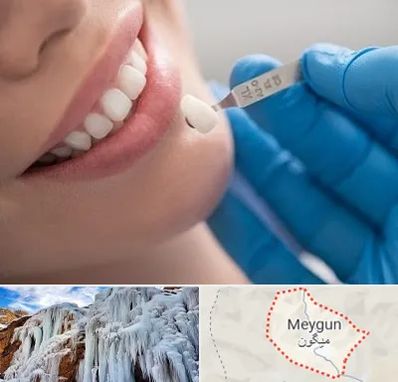 مرکز لمینت دندان در میگون