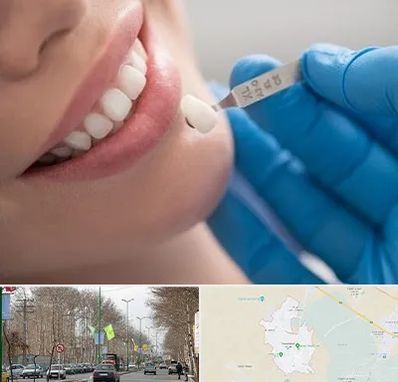 مرکز لمینت دندان در نظرآباد کرج