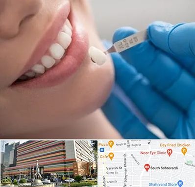 مرکز لمینت دندان در سهروردی