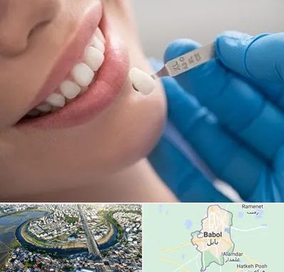 مرکز لمینت دندان در بابل