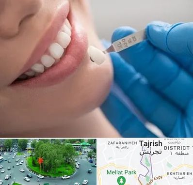 مرکز لمینت دندان در تجریش