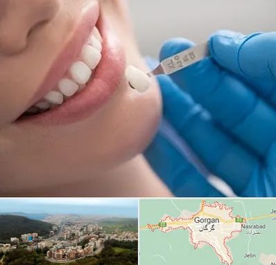 مرکز لمینت دندان در گرگان