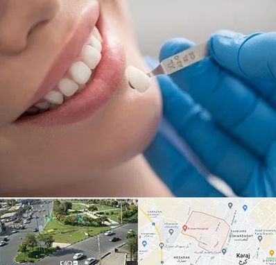 مرکز لمینت دندان در شاهین ویلا کرج
