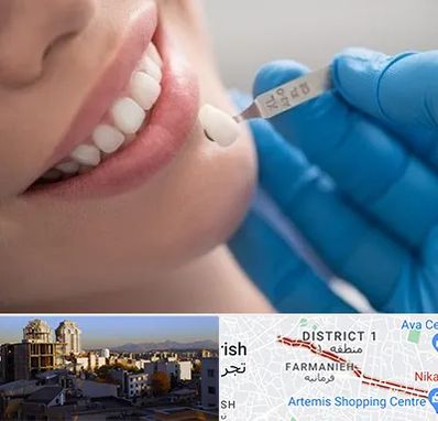مرکز لمینت دندان در فرمانیه
