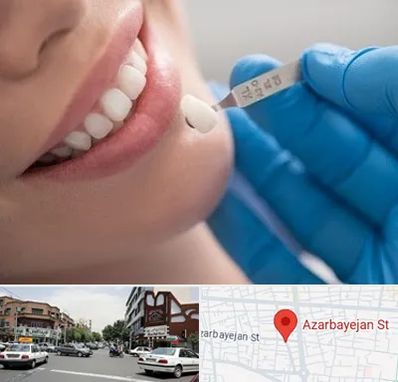 مرکز لمینت دندان در خیابان آذربایجان