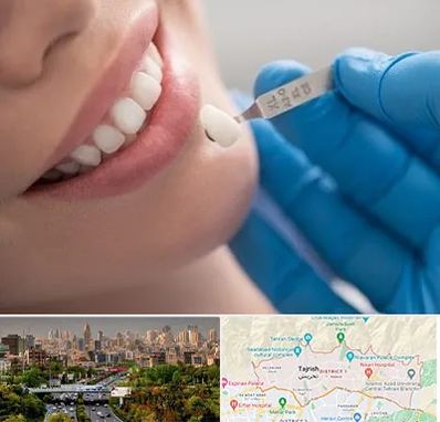 مرکز لمینت دندان در منطقه 1 تهران