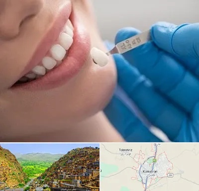 مرکز لمینت دندان در کامیاران