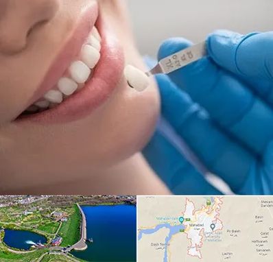 مرکز لمینت دندان در مهاباد