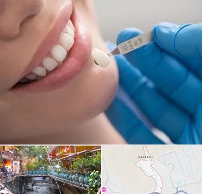 مرکز لمینت دندان در درکه