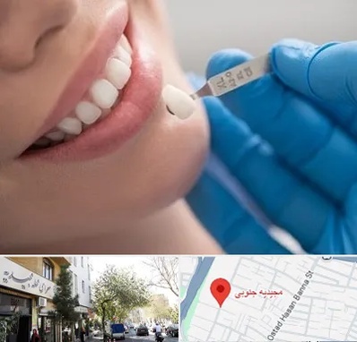 مرکز لمینت دندان در مجیدیه جنوبی