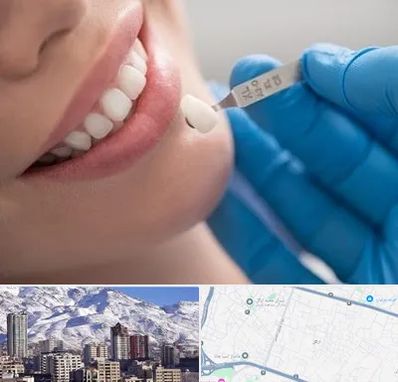 مرکز لمینت دندان در ازگل
