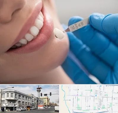 مرکز لمینت دندان در 17شهریور