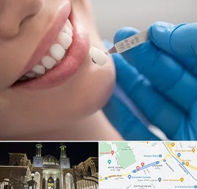 مرکز لمینت دندان در زرگری شیراز