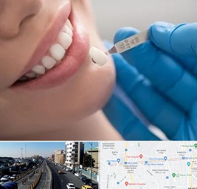 مرکز لمینت دندان در پیروزی