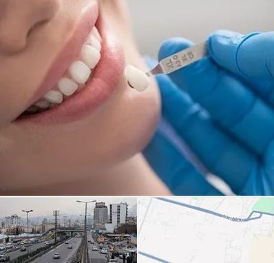 مرکز لمینت دندان در بلوار ارتش