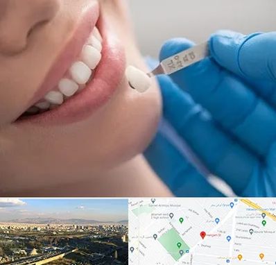 مرکز لمینت دندان در هنگام