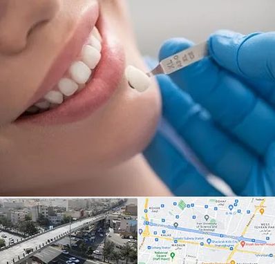 مرکز لمینت دندان در فرجام