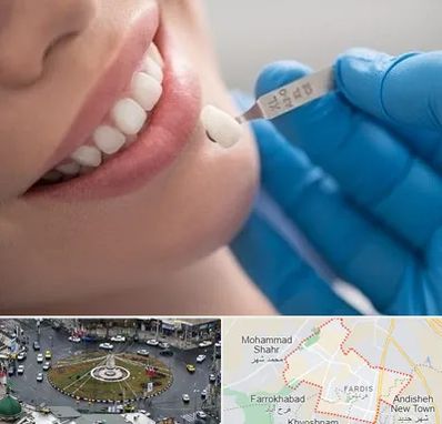 مرکز لمینت دندان در فردیس کرج