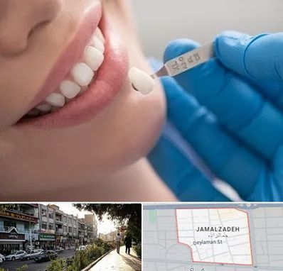 مرکز لمینت دندان در خیابان جمالزاده
