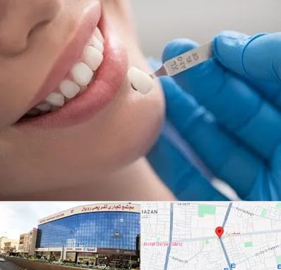مرکز لمینت دندان در نصف راه تبریز