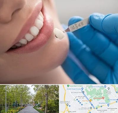 مرکز لمینت دندان در قدوسی غربی شیراز