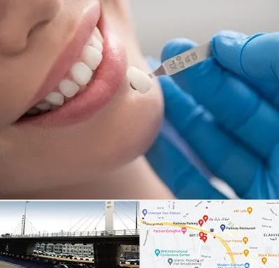 مرکز لمینت دندان در پارک وی