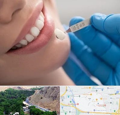 مرکز لمینت دندان در کن