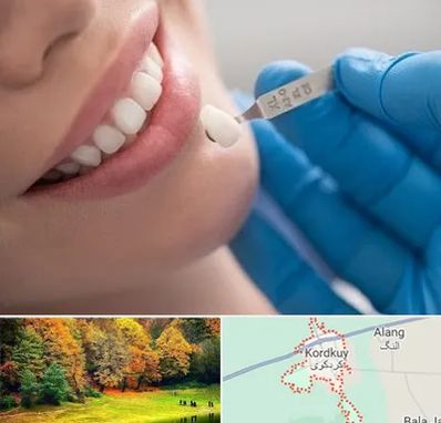 مرکز لمینت دندان در کردکوی