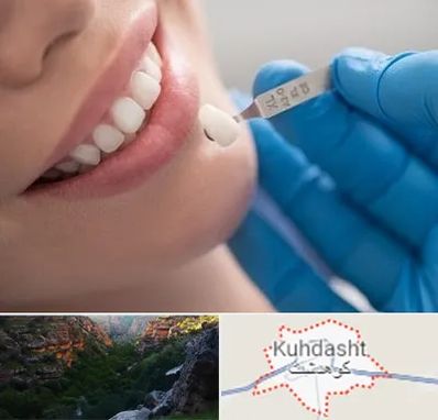 مرکز لمینت دندان در کوهدشت