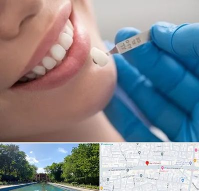 مرکز لمینت دندان در هشت بهشت اصفهان