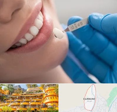 مرکز لمینت دندان در دربند